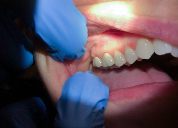 Best Chipped Tooth Repair Near Me  in Hartwell, GA